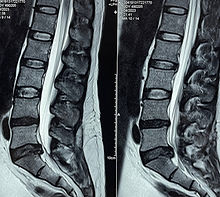 Hernia lumbar cirugía columna